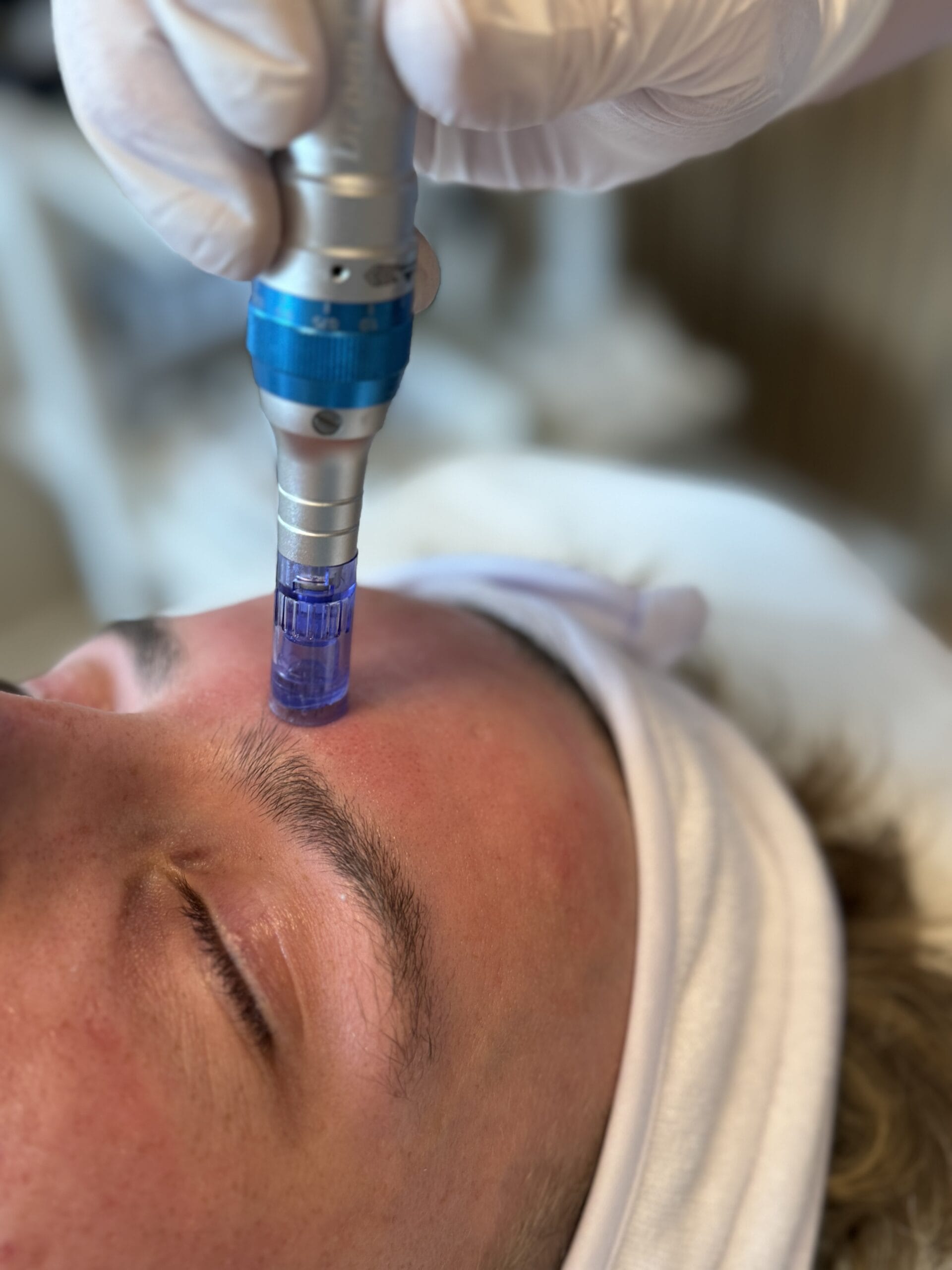 Microneedling fusion: Den nyeste revolution inden for hudpleje